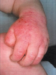 Gel per un teething a dermatite atopic